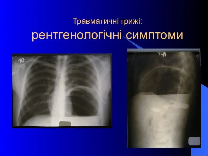 Травматичні грижі: рентгенологічні симптоми