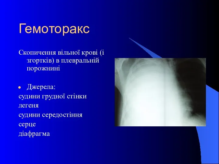 Гемоторакс Скопичення вільної крові (і згортків) в плевральній порожнині Джерела: судини