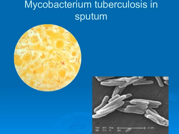 Mycobacterium tuberculosis in sputum