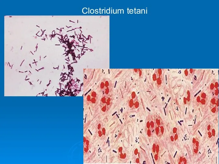 Clostridium tetani