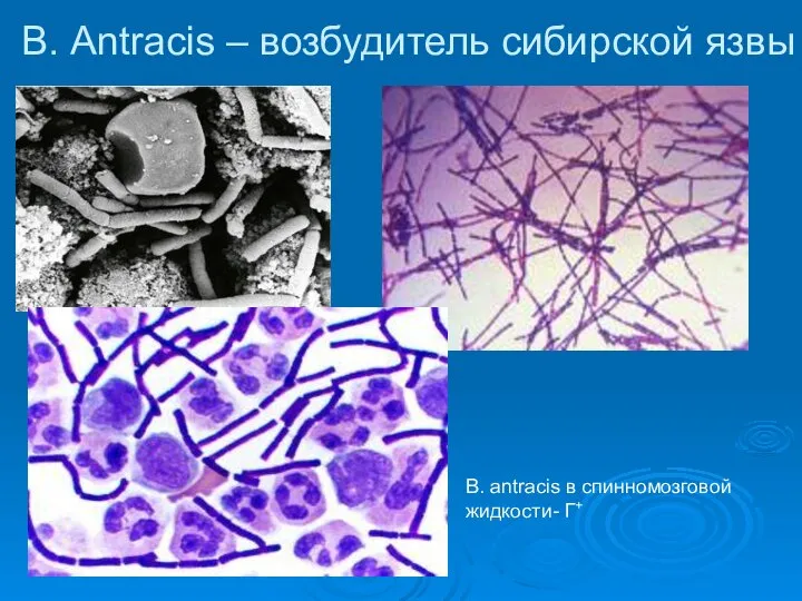 B. Аntracis – возбудитель сибирской язвы B. аntracis в спинномозговой жидкости- Г+