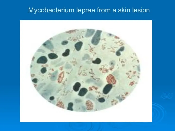 Mycobacterium leprae from a skin lesion