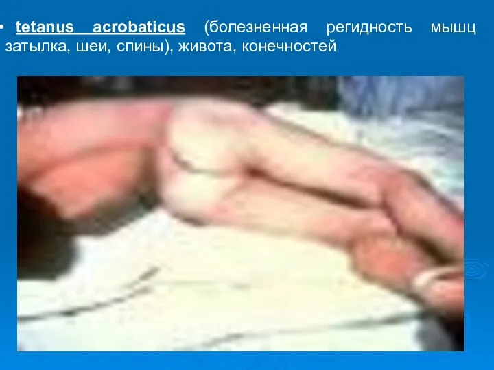 tetanus acrobaticus (болезненная регидность мышц затылка, шеи, спины), живота, конечностей