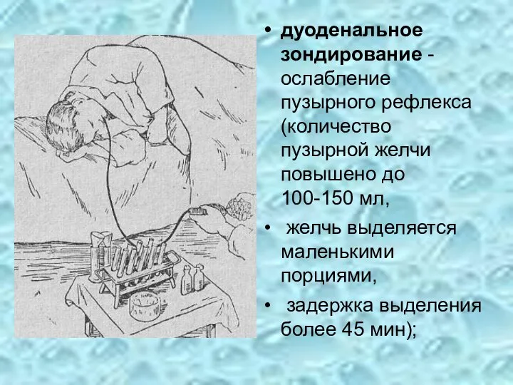 дуоденальное зондирование - ослабление пузырного рефлекса (количество пузырной желчи повышено до