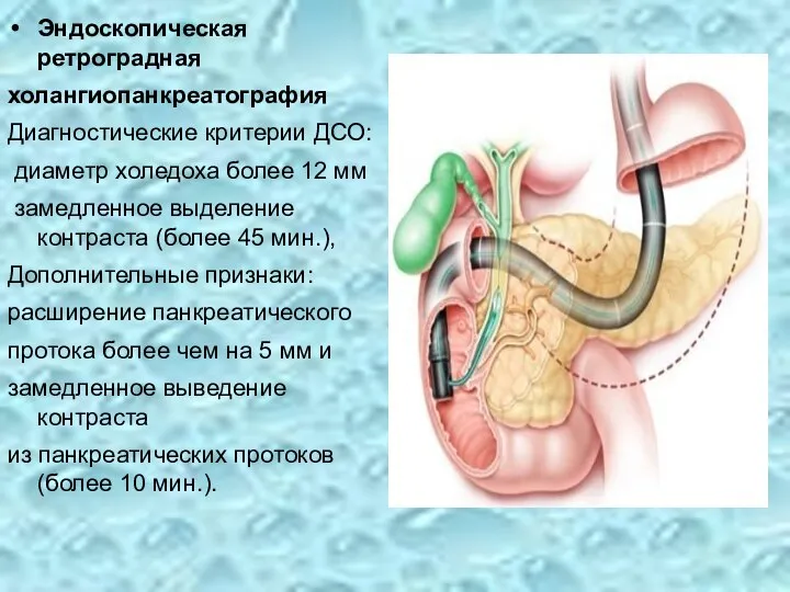 Эндоскопическая ретроградная холангиопанкреатография Диагностические критерии ДСО: диаметр холедоха более 12 мм