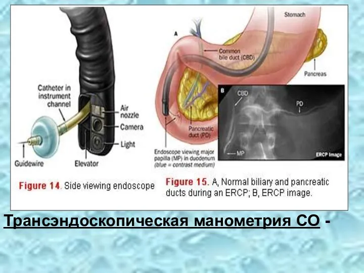 Трансэндоскопическая манометрия СО -