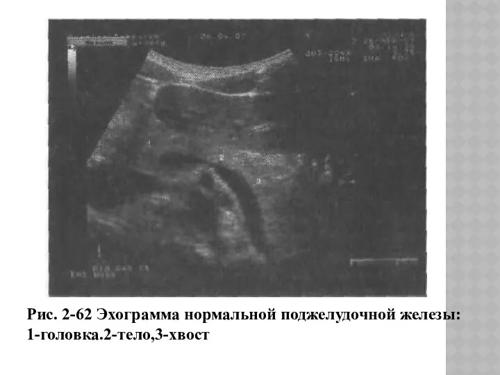 Рис. 2-62 Эхограмма нормальной поджелудочной железы: 1-головка.2-тело,3-хвост