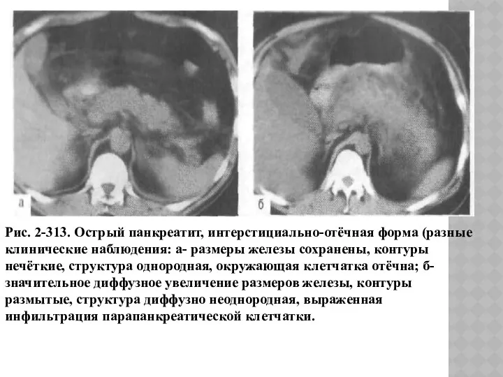 Рис. 2-313. Острый панкреатит, интерстициально-отёчная форма (разные клинические наблюдения: а- размеры