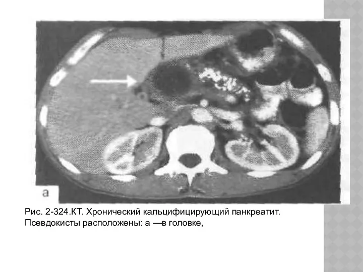 Рис. 2-324.КТ. Хронический кальцифицирующий панкреатит. Псевдокисты расположены: а —в головке,