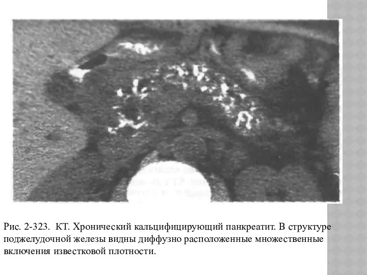 Рис. 2-323. КТ. Хронический кальцифицирующий панкреатит. В структуре поджелудочной железы видны