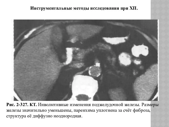 Рис. 2-327. КТ. Инволютивные изменения поджелудочной железы. Размеры железы значительно уменьшены,