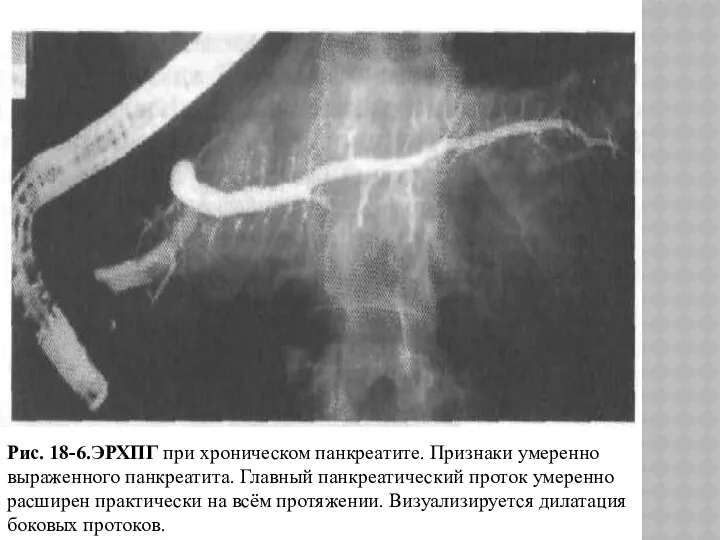 Рис. 18-6.ЭРХПГ при хроническом панкреатите. Признаки умеренно выраженного панкреатита. Главный панкреатический