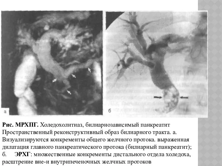 Рис. МРХПГ. Холедохолитиаз, билиарнозависимый панкреатит Пространственный реконструктивный образ билиарного тракта. а.