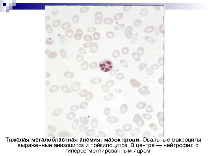 Тяжелая мегалобластная анемия: мазок крови. Овальные макроциты, выраженные анизоцитоз и пойкилоцитоз.