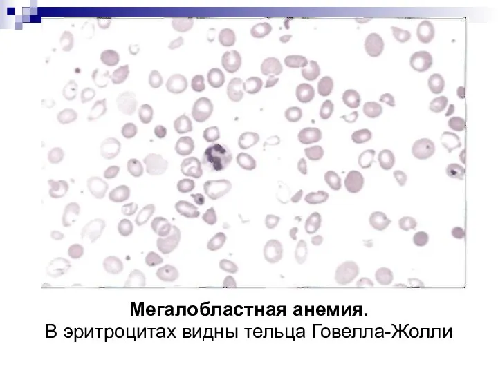 Мегалобластная анемия. В эритроцитах видны тельца Говелла-Жолли