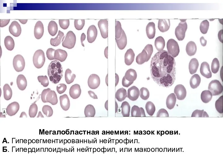 Мегалобластная анемия: мазок крови. А. Гиперсегментированный нейтрофил. Б. Гипердиплоидный нейтрофил, или макоополииит.