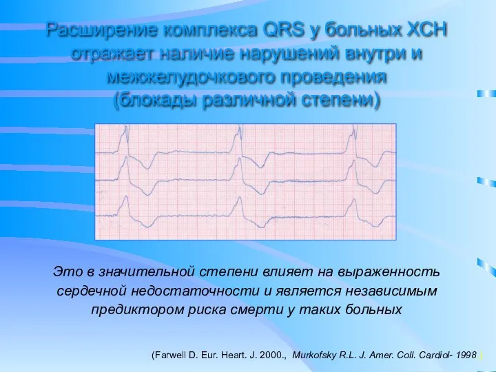 Расширение комплекса QRS у больных ХСН отражает наличие нарушений внутри и