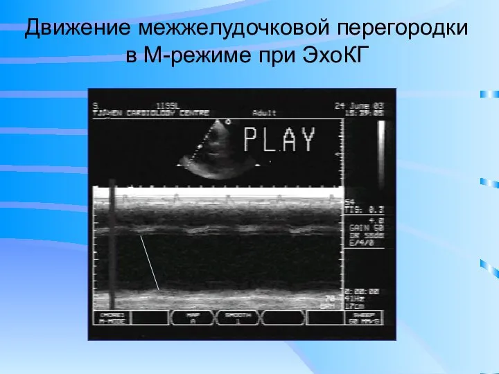 Движение межжелудочковой перегородки в М-режиме при ЭхоКГ