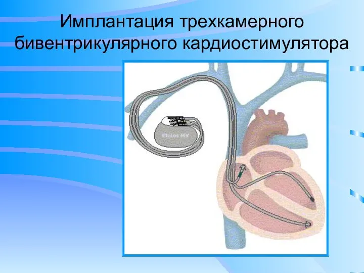 Имплантация трехкамерного бивентрикулярного кардиостимулятора
