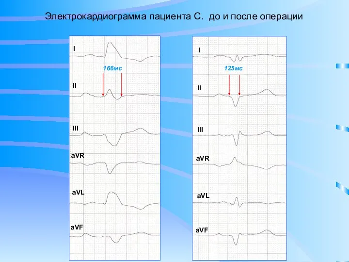 I II III aVR aVL aVF I II III aVR aVL