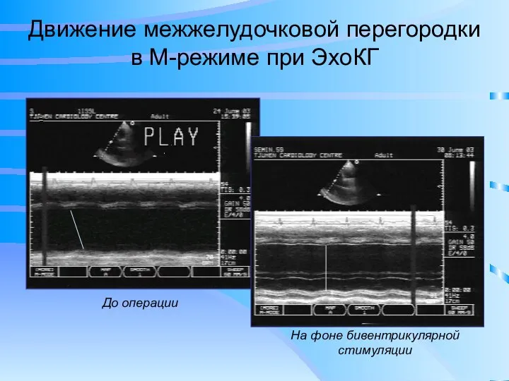 Движение межжелудочковой перегородки в М-режиме при ЭхоКГ До операции На фоне бивентрикулярной стимуляции