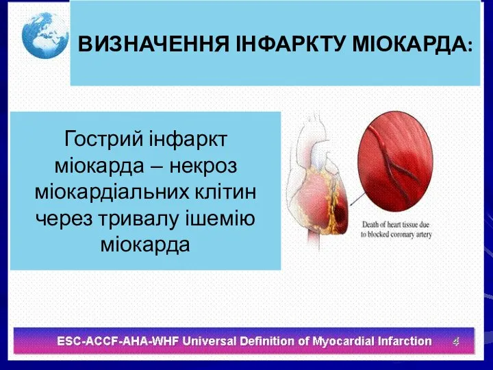 ВИЗНАЧЕННЯ ІНФАРКТУ МІОКАРДА: Гострий інфаркт міокарда – некроз міокардіальних клітин через тривалу ішемію міокарда