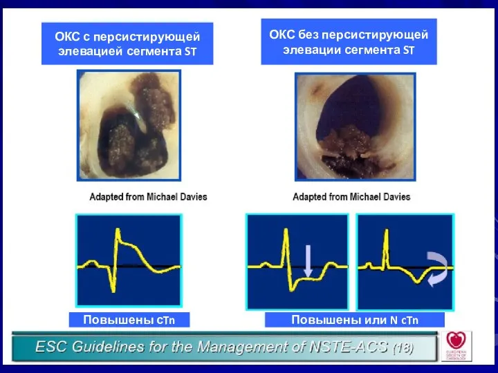 ОКС с персистирующей элевацией сегмента ST ОКС без персистирующей элевации сегмента