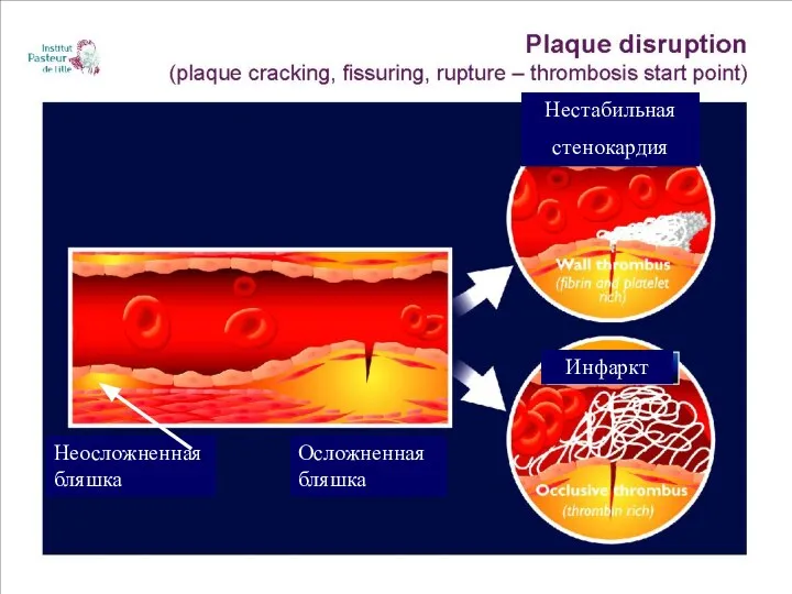 Нестабильная стенокардия Инфаркт Неосложненная бляшка Осложненная бляшка