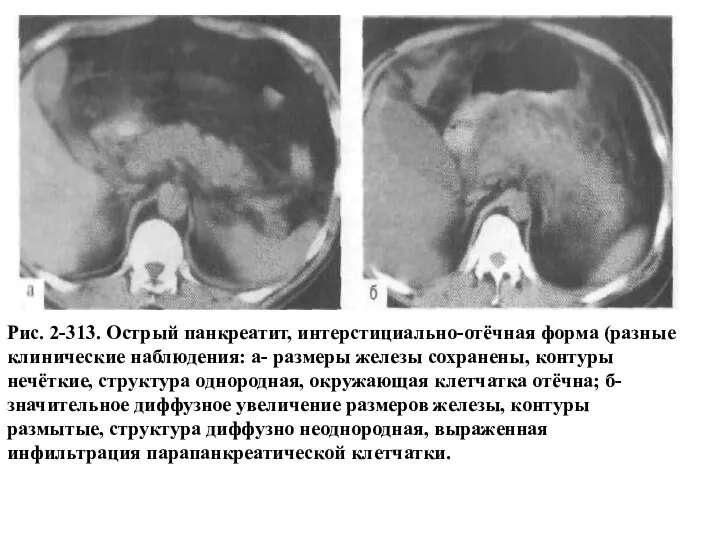 Рис. 2-313. Острый панкреатит, интерстициально-отёчная форма (разные клинические наблюдения: а- размеры