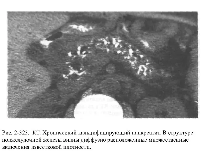 Рис. 2-323. КТ. Хронический кальцифицирующий панкреатит. В структуре поджелудочной железы видны