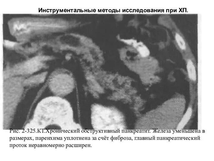 Рис. 2-325.КТ.Хронический обструктивный панкреатит. Железа уменьшена в размерах, паренхима уплотнена за