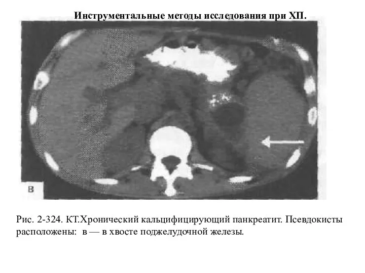 Рис. 2-324. КТ.Хронический кальцифицирующий панкреатит. Псевдокисты расположены: в — в хвосте