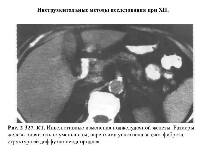 Рис. 2-327. КТ. Инволютивные изменения поджелудочной железы. Размеры железы значительно уменьшены,