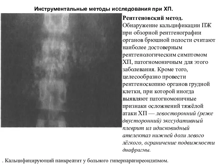 . Кальцифицирующий панкреатит у больного гиперпаратиреоидизмом. Инструментальные методы исследования при ХП.