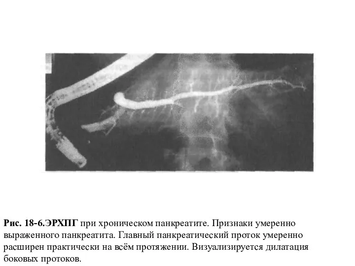 Рис. 18-6.ЭРХПГ при хроническом панкреатите. Признаки умеренно выраженного панкреатита. Главный панкреатический