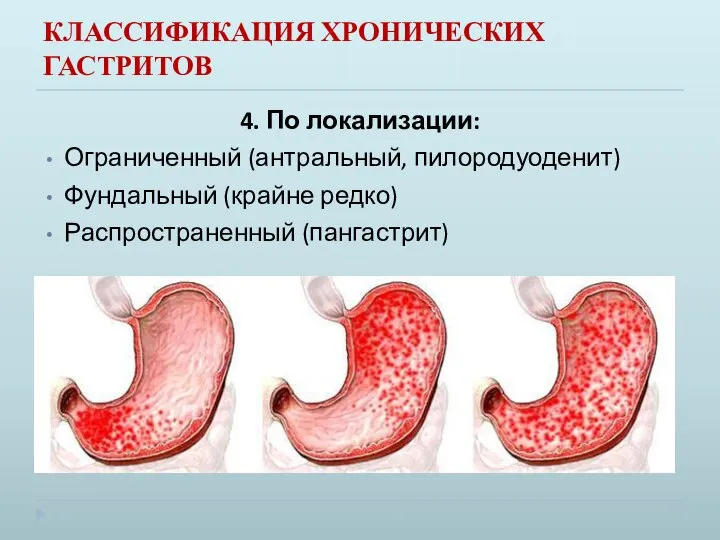 КЛАССИФИКАЦИЯ ХРОНИЧЕСКИХ ГАСТРИТОВ 4. По локализации: Ограниченный (антральный, пилородуоденит) Фундальный (крайне