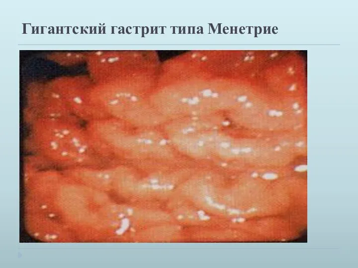 Гигантский гастрит типа Менетрие Слизистая оболочка