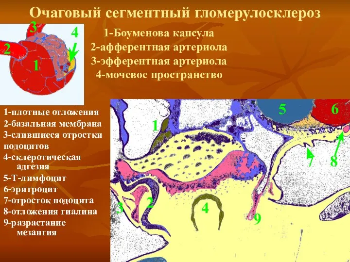 Очаговый сегментный гломерулосклероз 1-плотные отложения 2-базальная мембрана 3-слившиеся отростки подоцитов 4-склеротическая