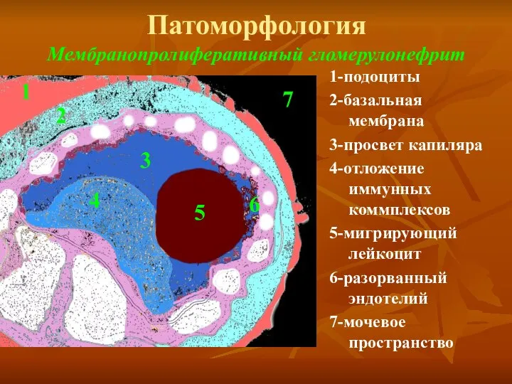 Патоморфология Мембранопролиферативный гломерулонефрит 1-подоциты 2-базальная мембрана 3-просвет капиляра 4-отложение иммунных коммплексов