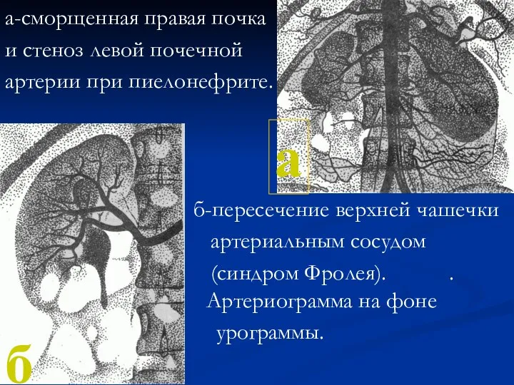 а-сморщенная правая почка и стеноз левой почечной артерии при пиелонефрите. б-пересечение