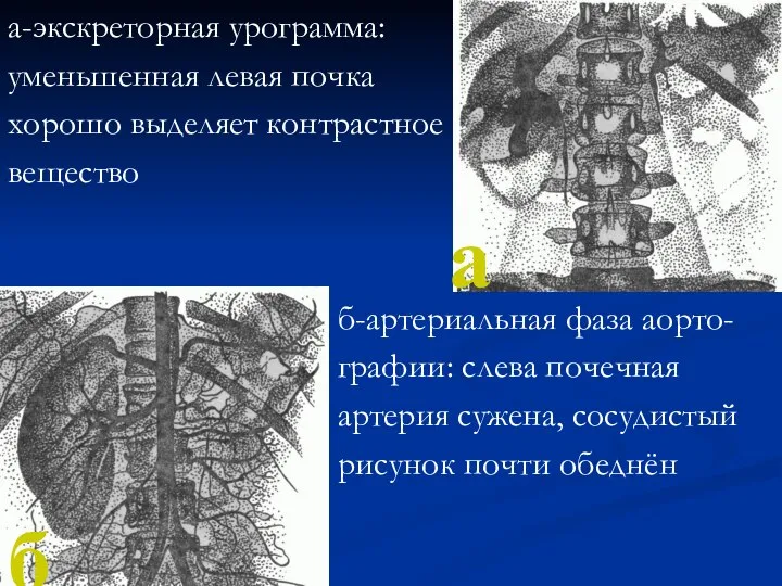 а-экскреторная урограмма: уменьшенная левая почка хорошо выделяет контрастное вещество б-артериальная фаза