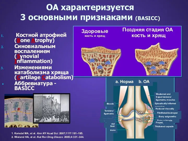 OA характеризуется 3 основными признаками (BASICC) Костной атрофией (Bone Atrophy) Синовиальным