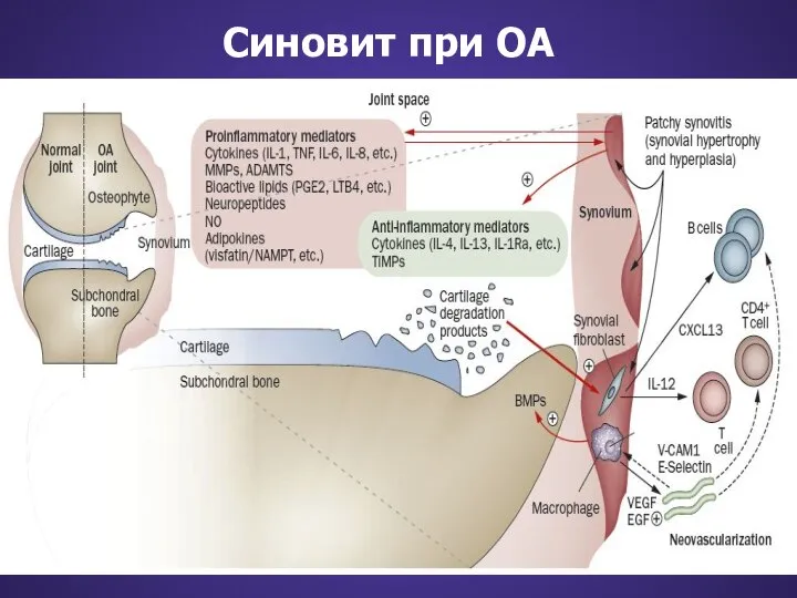 Синовит при ОА