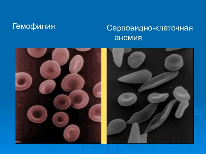 Гемофилия Серповидно-клеточная анемия