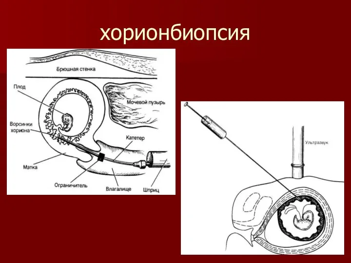 хорионбиопсия