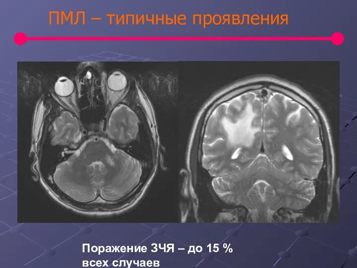 ПМЛ – типичные проявления Поражение ЗЧЯ – до 15 % всех случаев