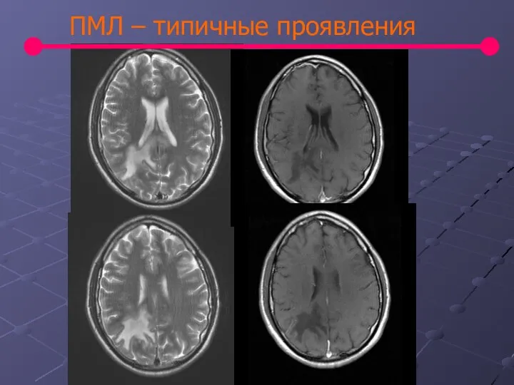 ПМЛ – типичные проявления