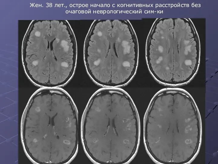 Жен. 38 лет., острое начало с когнитивных расстройств без очаговой неврологический сим-ки