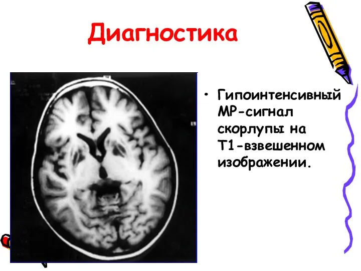 Диагностика Гипоинтенсивный МР-сигнал скорлупы на Т1-взвешенном изображении.