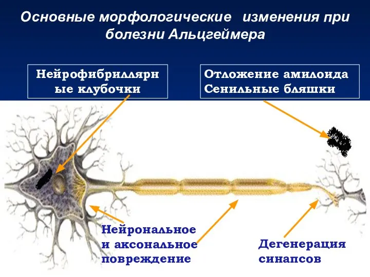 Нейрофибриллярные клубочки Нейрональное и аксональное повреждение Дегенерация синапсов Отложение амилоида Сенильные